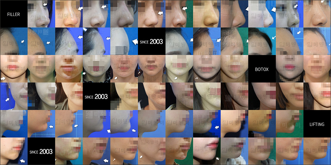SINCE 2003 MI&MI, 시술후사진모음 목동사각턱보톡스,목동역사각턱보톡스,목동보톡스,목동역보톡스,목동턱보톡스,목동역턱보톡스,목동종아리보톡스,목동역종아리보톡스,목동주름보톡스,목동역주름보톡스,목동승모근보톡스,목동역승모근보톡스,목동더모톡신,목동역더모톡신,목동V라인주사,목동역V라인주사,목동액취증,목동역액취증,목동다한증,목동역다한증