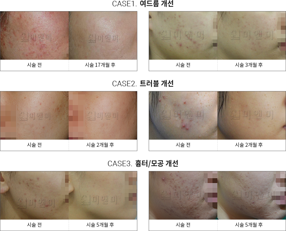 시술전후사진 : 목동여드름흉터,목동역여드름흉터,목동여드름,목동역여드름,목동모공,목동역모공,목동블랙헤드,목동역블랙헤드,목동셀라스,목동역셀라스,목동PDT,목동역PDT,목동MTS,목동역MTS,목동스킨스케일링,목동역스킨스케일링,목동스피큘링,목동역스피큘링,목동아쿠아필,목동역아쿠아필