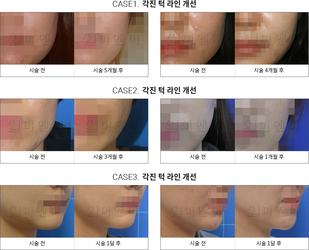 시술전후사진 사각턱 보톡스 : 각진 턱 라인 개선 목동사각턱보톡스,목동역사각턱보톡스,목동보톡스,목동역보톡스,목동턱보톡스,목동역턱보톡스,목동종아리보톡스,목동역종아리보톡스,목동주름보톡스,목동역주름보톡스,목동승모근보톡스,목동역승모근보톡스,목동더모톡신,목동역더모톡신,목동V라인주사,목동역V라인주사,목동액취증,목동역액취증,목동다한증,목동역다한증