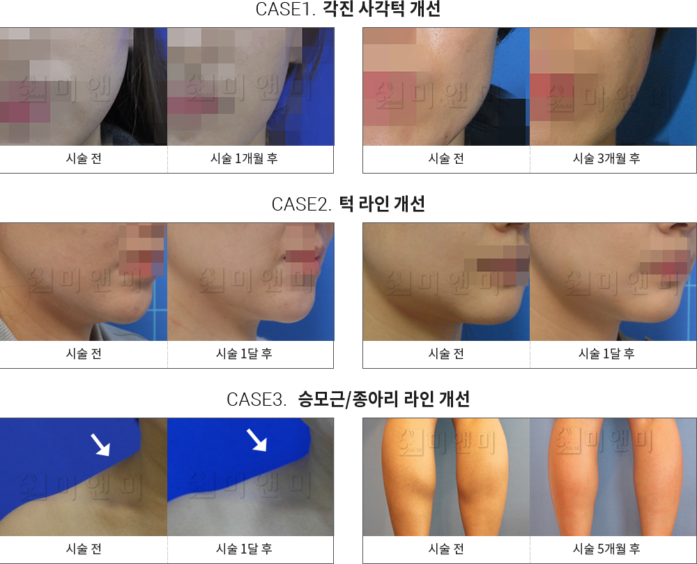 시술전후사진 승모근 보톡스 : 각진 사각턱 개선,턱 라인 개선,승모근/종아리 라인 개선 목동승모근보톡스,목동역승모근보톡스,목동보톡스,목동역보톡스,목동사각턱보톡스,목동역사각턱보톡스,목동턱보톡스,목동역턱보톡스,목동주름보톡스,목동역주름보톡스,목동더모톡신,목동역더모톡신,목동V라인주사,목동역V라인주사,목동액취증,목동역액취증,목동다한증,목동역다한증