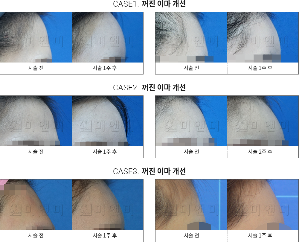 시술전후사진 이마필러 : 무턱개선 목동이마필러, 목동역이마필러