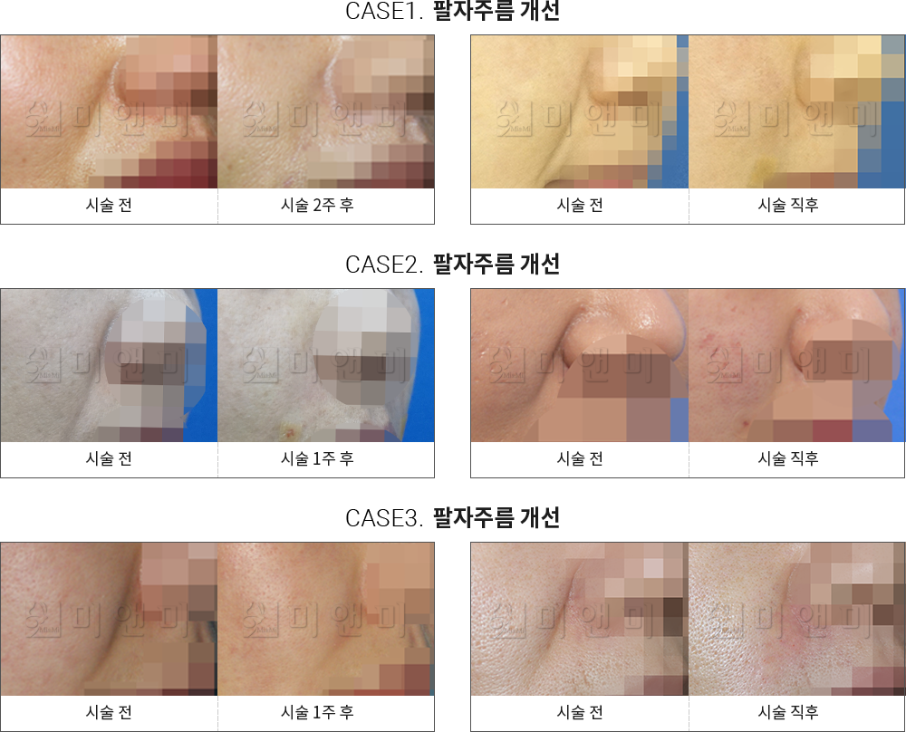 시술전후사진 팔자필러 : 팔자주름 개선 목동팔자필러,목동역팔자필러,목동팔자주름필러, 목동역팔자주름필러, 목동코필러, 목동역코필러, 목동필러, 목동역필러, 목동무턱필러, 목동역무턱필러, 목동볼필러, 목동역볼필러, 목동이마필러, 목동역이마필러, 목동얼굴필러, 목동역얼굴필러, 목동주름필러, 목동역주름필러, 목동애교필러, 목동역애교필러, 목동입술필러, 목동역입술필러
