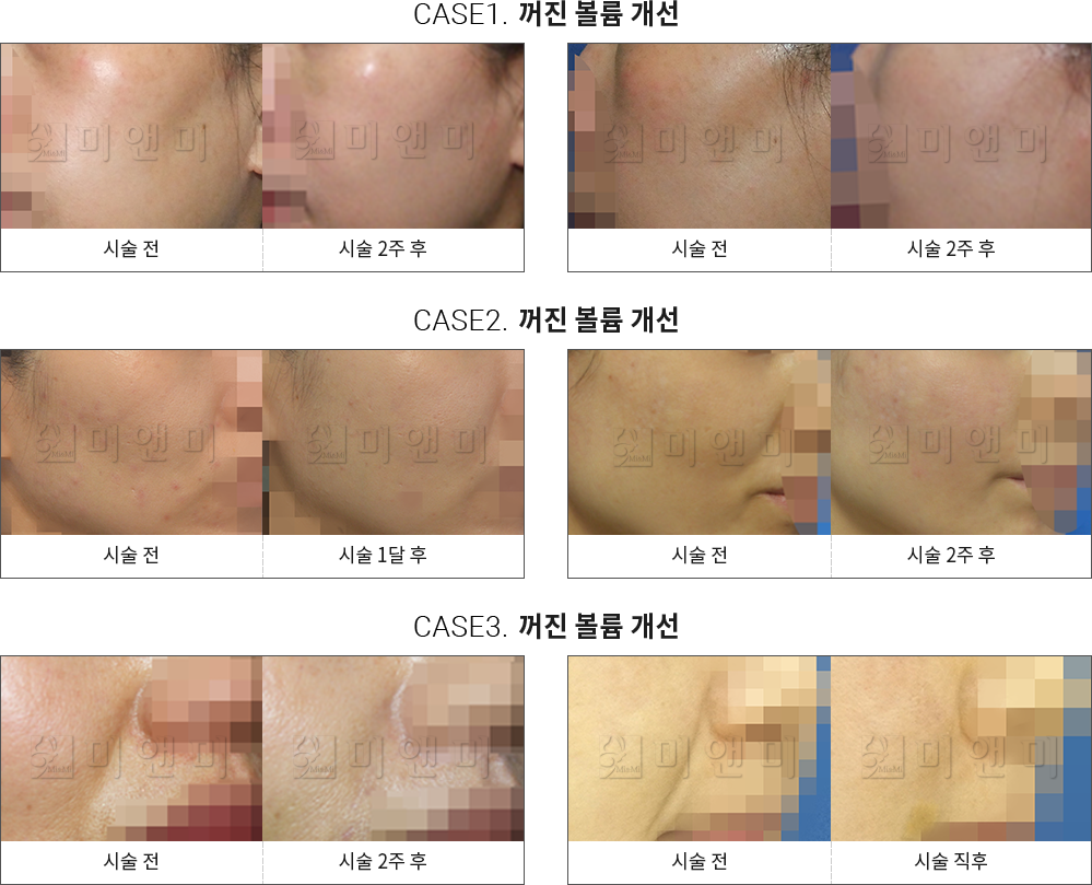 시술전후사진 큐오필 : 꺼진 볼륨 개선 목동큐오필, 목동역큐오필, 목동필러, 목동역필러, 목동코필러, 목동역코필러, 목동무턱필러, 목동역무턱필러, 목동볼필러, 목동역볼필러, 목동이마필러, 목동역이마필러, 목동얼굴필러, 목동역얼굴필러, 목동주름필러, 목동역주름필러, 목동애교필러, 목동역애교필러,목동팔자주름필러, 목동역팔자주름필러, 목동입술필러, 목동역입술필러